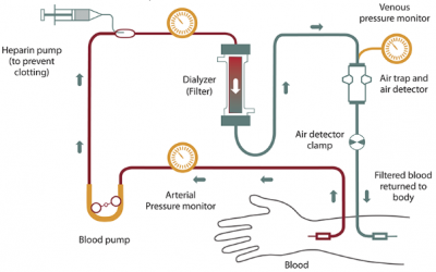 Le processus de traitement d’hémodialyse